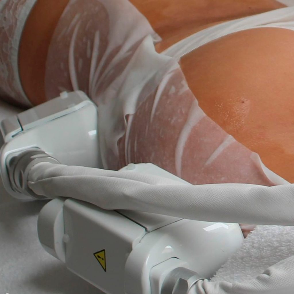 cryoliposculpt bari