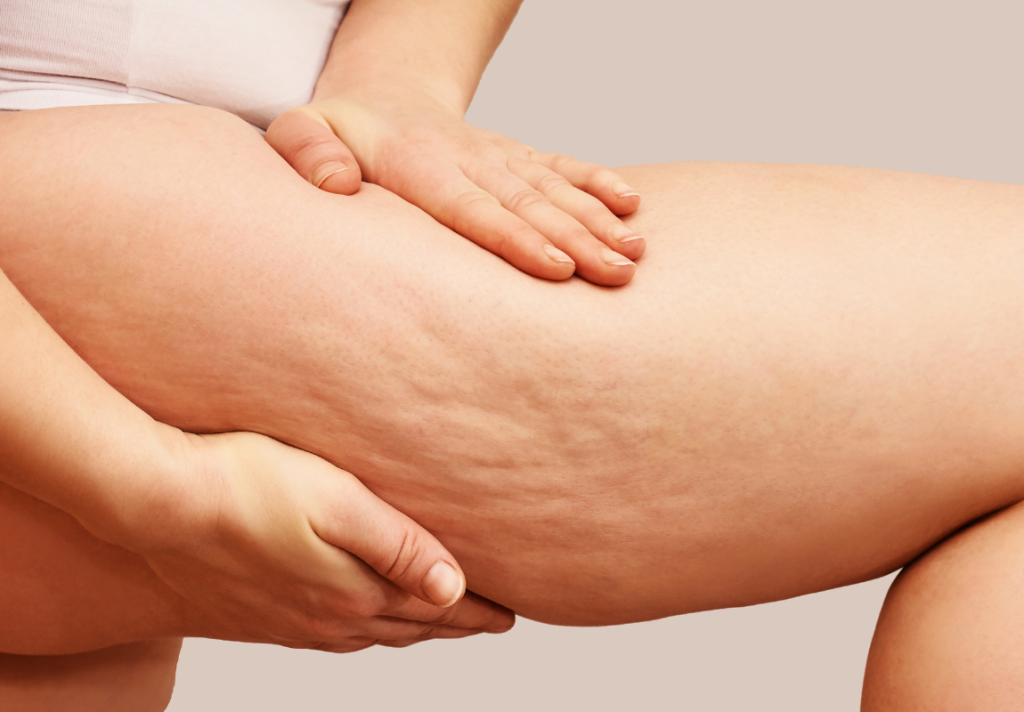 combattere la cellulite