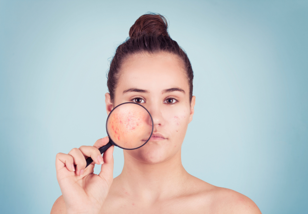 cicatrici acne 