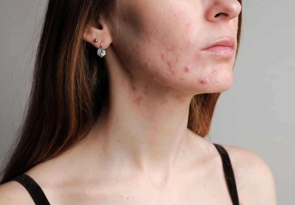 dermapen acne