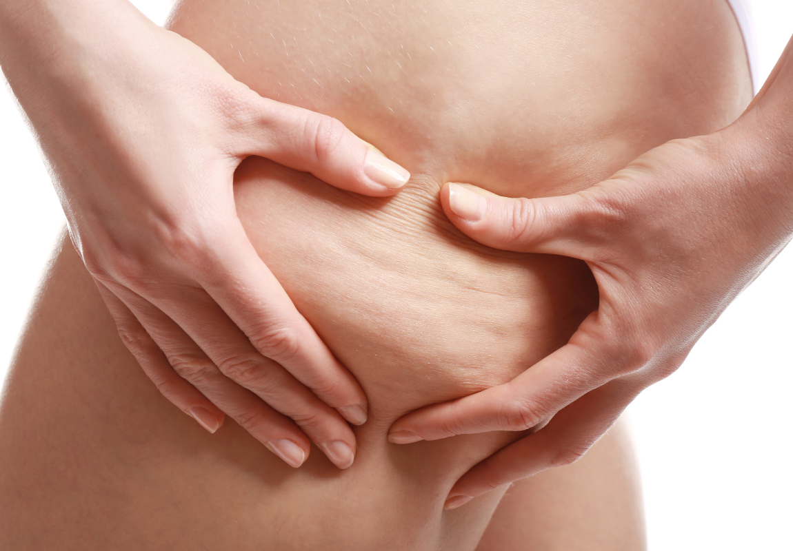 cellulite e ritenzione idrica