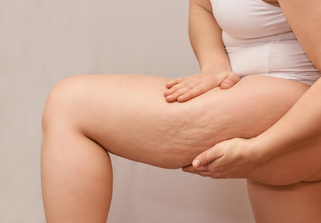 cellulite e ritenzione idrica