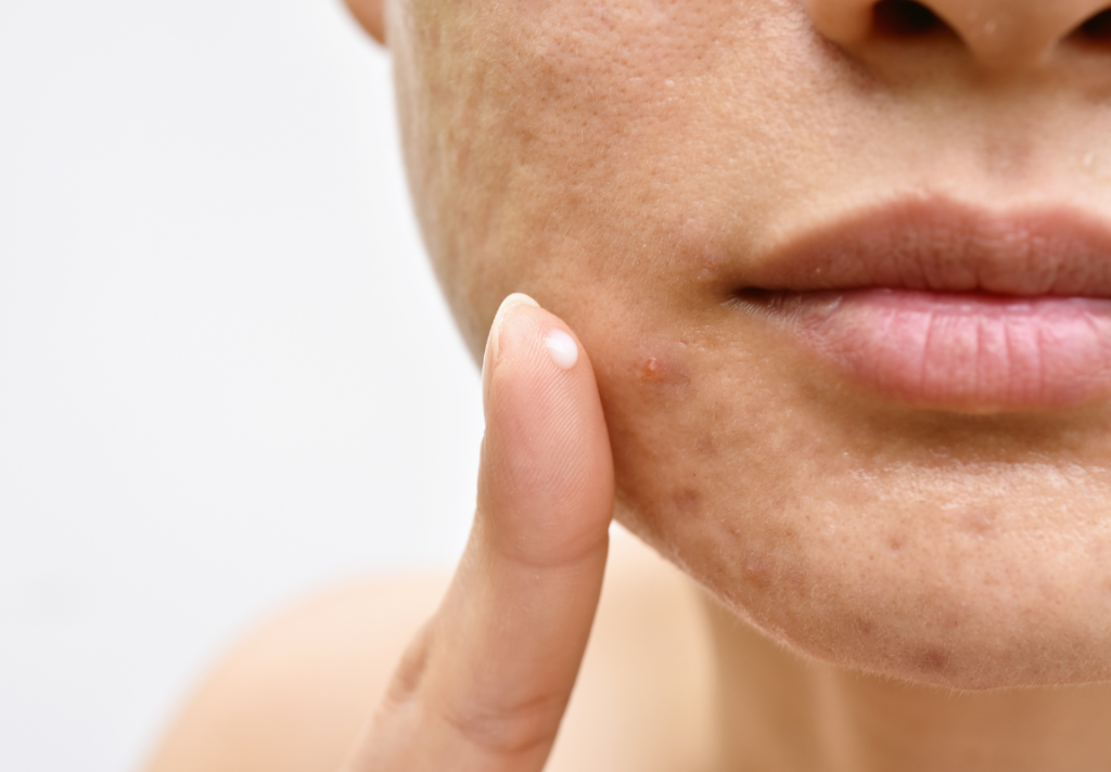 acne tardiva