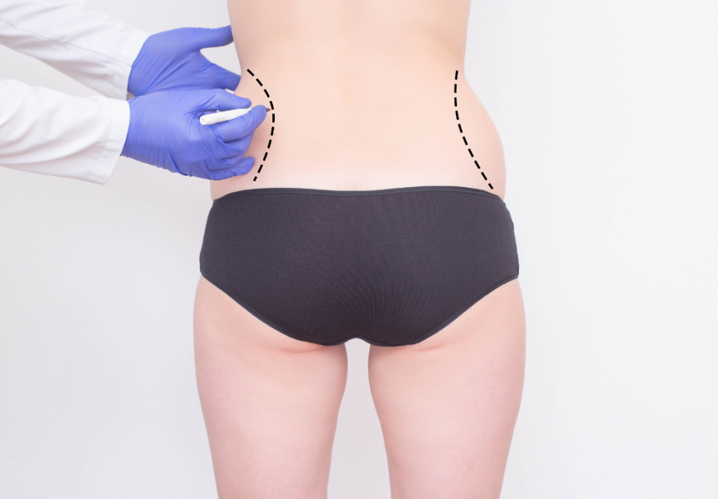 lipofilling